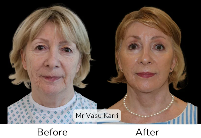 Facelift Patient 8 View 1
